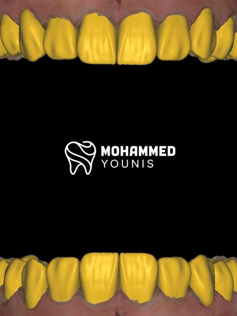 Luxury smile brand — gold wax-up