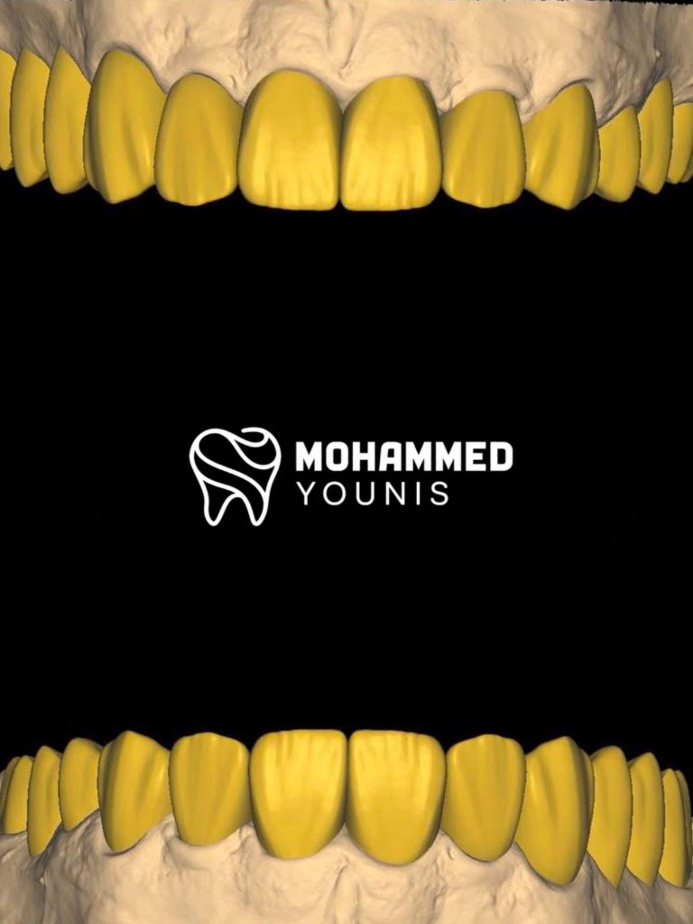 Luxury smile brand — yellow wax-up